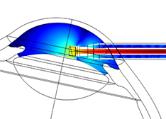 Grafik Ausbreitung Ultraschall-Energie in der Vorderkammer des Auges