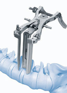 Visualisierung eines Retraktors: Operationshilfsmittel, um Weichteile  wie Muskeln, Bänder oder Fettgewebe zu spreizen und dem Chirurgen einen sicheren Zugang zur Operationsstelle, z.B.  Wirbelsäule, zu gewährleisten