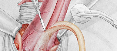 Genital-Operation, Illustration von Manuel Ruoss