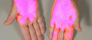 Skin App: Die Computerdiagnose (hier lila) deckt sich in den pinkfarbenen Bereichen mit der Arztdiagnose (hier rot). (Bild: Hochschule Luzern)