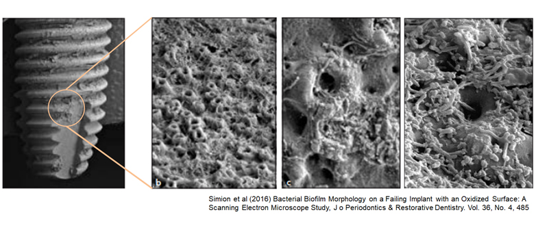 Periimplantitis Collage